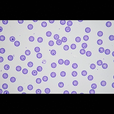 Microscopic view of lymphoblasts in blood smear, medical research, no text, no words, no typography, clean image