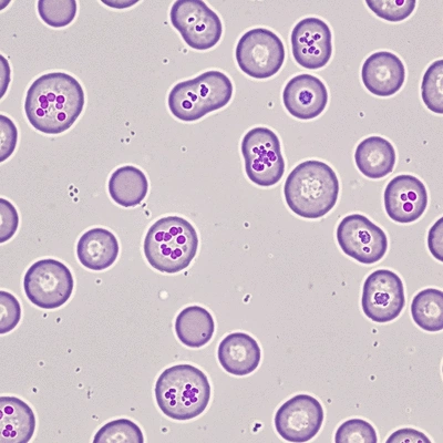 Microscopic view of CMML blood cells
